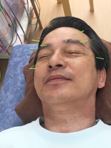 眼精疲労鍼治療の様子