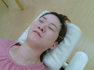 美容鍼施術中の様子